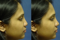 non-surgical rhinoplasty