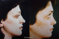 surgical-rhinoplasty