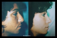 surgical-rhinoplasty