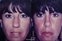 surgical-rhinoplasty