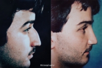 surgical-rhinoplasty