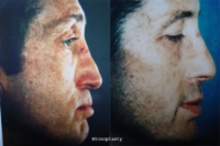 surgical-rhinoplasty