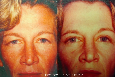 upper eyelid blepharoplasty