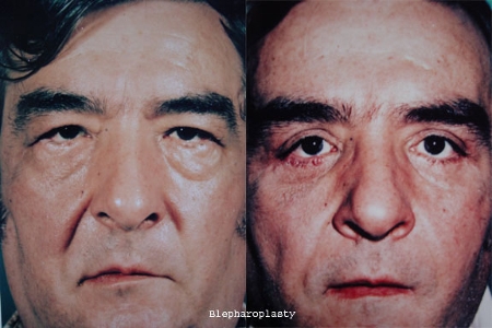 blepharoplasty