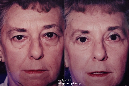 blepharoplasty