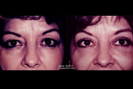 upper eyelid surgery