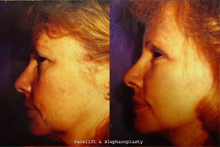 blepharoplasty and facelift