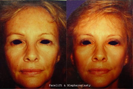 blepharoplasty and facelift