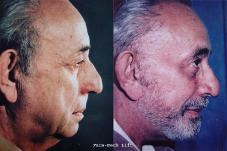 facelift and necklift