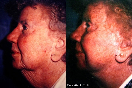 facelift and necklift