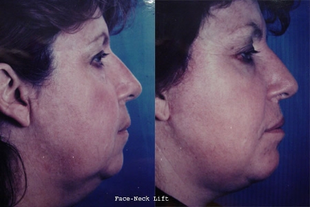 facelift and necklift