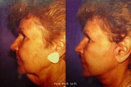 facelift and necklift